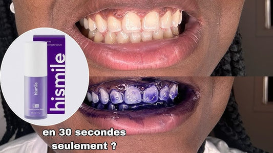 blanchiment dentaire